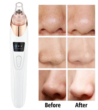5-in-1 Derma Suction Blackhead Remover Machine